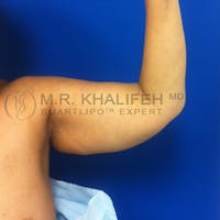 Arm Liposuction Gallery - Patient 3761770 - Image 1