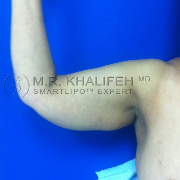 Arm Liposuction Gallery - Patient 3761770 - Image 3