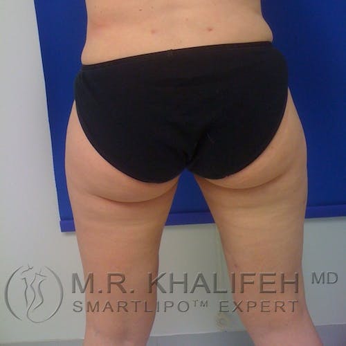 Inner Thigh Liposuction Gallery - Patient 3761769 - Image 6