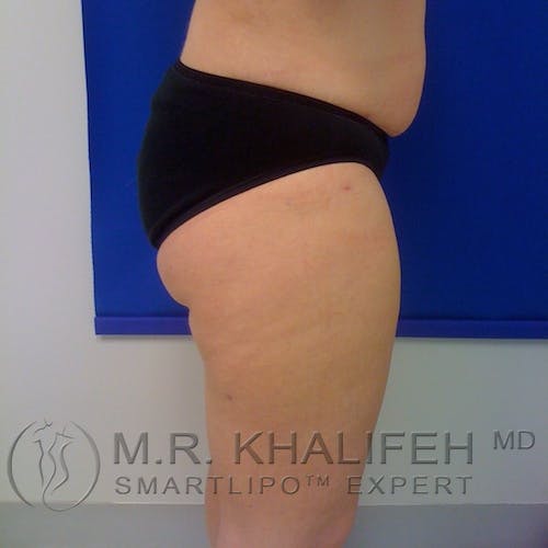 Inner Thigh Liposuction Gallery - Patient 3761769 - Image 8