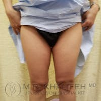 Inner Thigh Liposuction Gallery - Patient 3761776 - Image 1