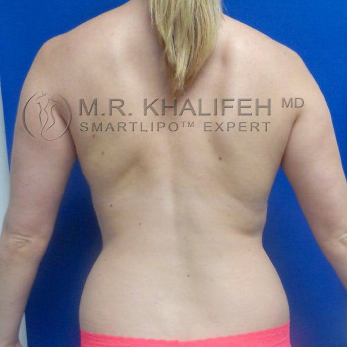 Flank-Lower Back Liposuction Gallery - Patient 92882090 - Image 1