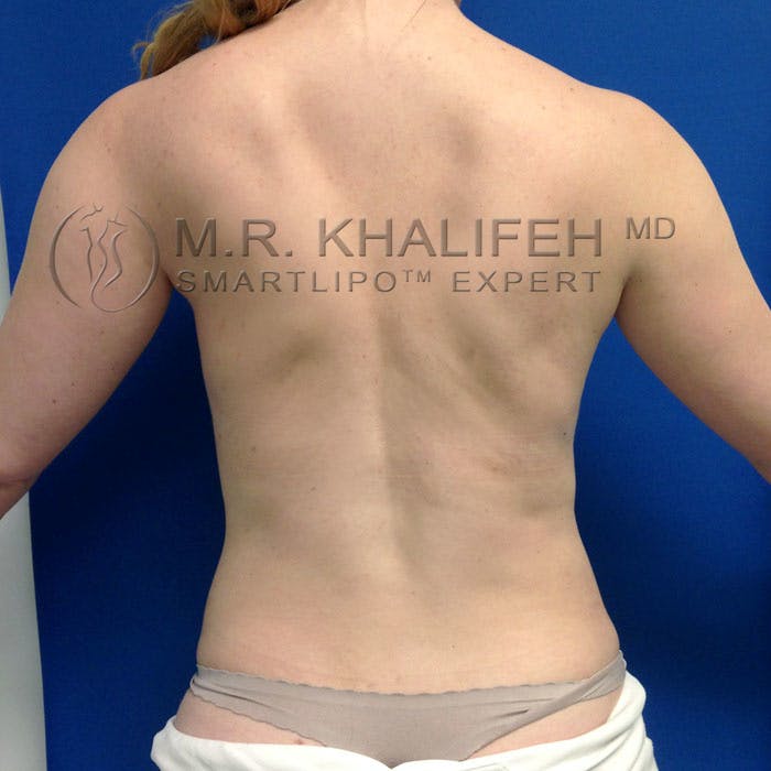 Flank-Lower Back Liposuction Gallery - Patient 92882090 - Image 2