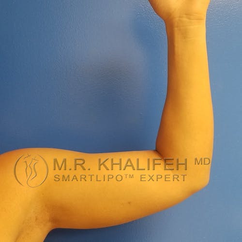 Arm Liposuction Gallery - Patient 3761783 - Image 1