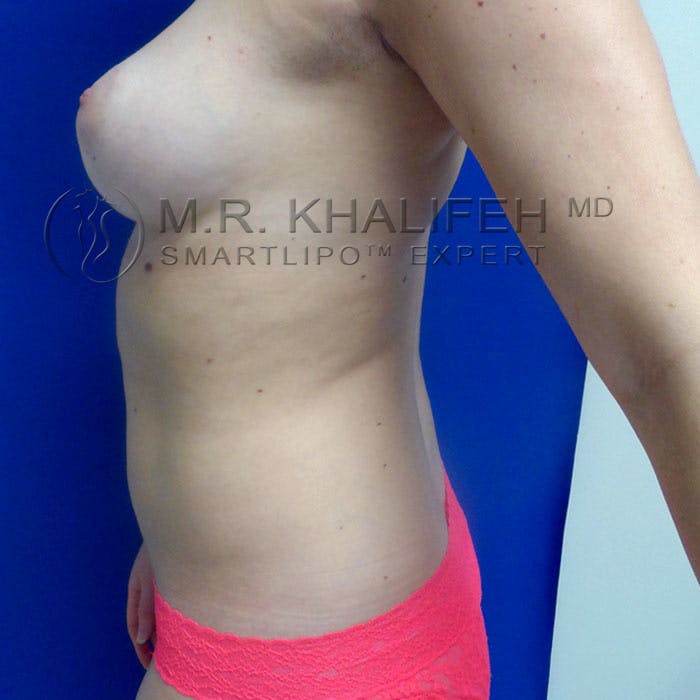 Flank-Lower Back Liposuction Gallery - Patient 92882090 - Image 5
