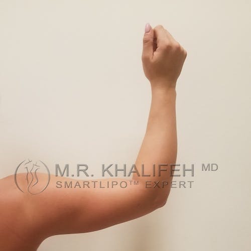 Arm Liposuction Gallery - Patient 3761783 - Image 4