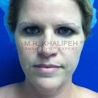 Chin and Neck Liposuction Gallery - Patient 3761786 - Image 1