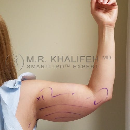 Arm Liposuction Gallery - Patient 3761789 - Image 1