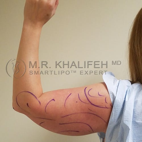 Arm Liposuction Gallery - Patient 3761789 - Image 3