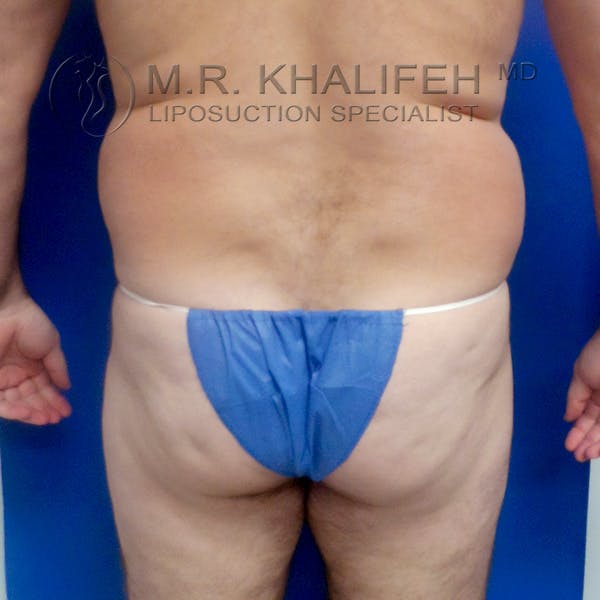 Male Liposuction Gallery - Patient 92882091 - Image 1