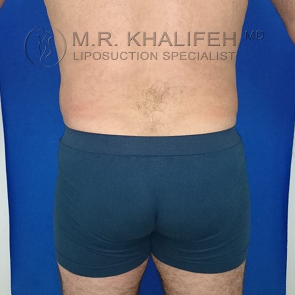 Male Liposuction Gallery - Patient 92882091 - Image 2