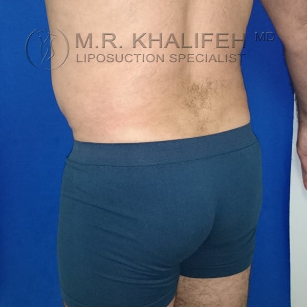 Male Liposuction Gallery - Patient 92882091 - Image 4