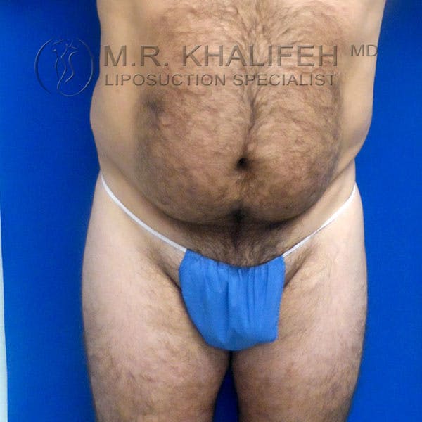 Male Liposuction Gallery - Patient 92882091 - Image 5