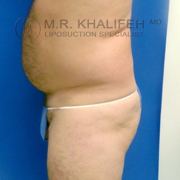 Male Liposuction Gallery - Patient 92882091 - Image 7