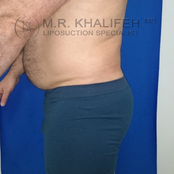 Male Liposuction Gallery - Patient 92882091 - Image 8