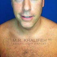 Chin and Neck Liposuction Gallery - Patient 3761802 - Image 1
