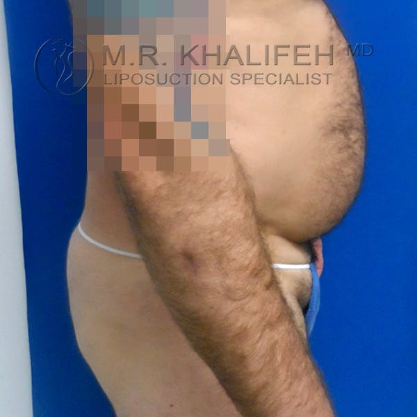 Male Liposuction Gallery - Patient 92882091 - Image 9