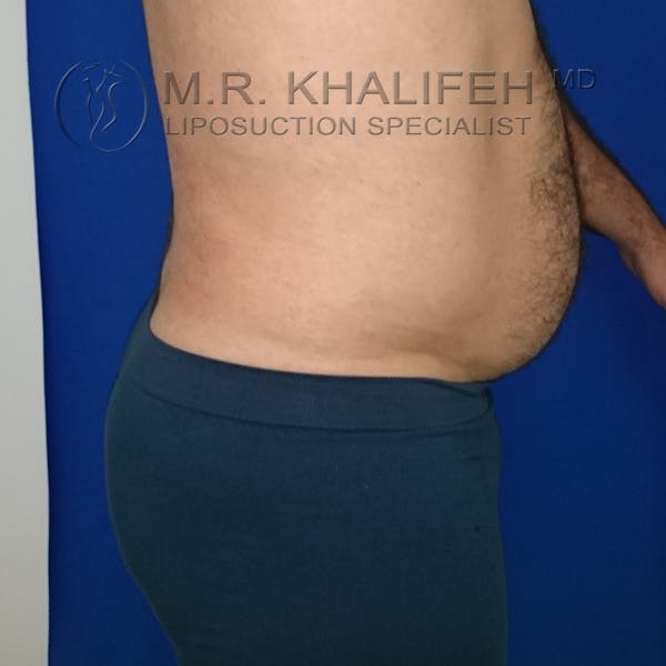 Male Liposuction Gallery - Patient 92882091 - Image 10
