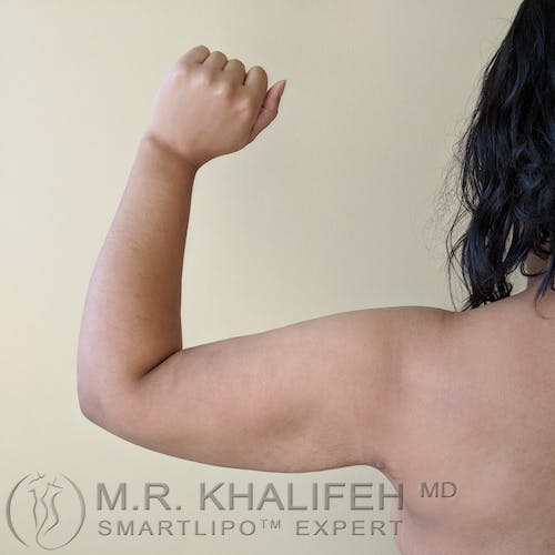 Arm Liposuction Gallery - Patient 3761807 - Image 2