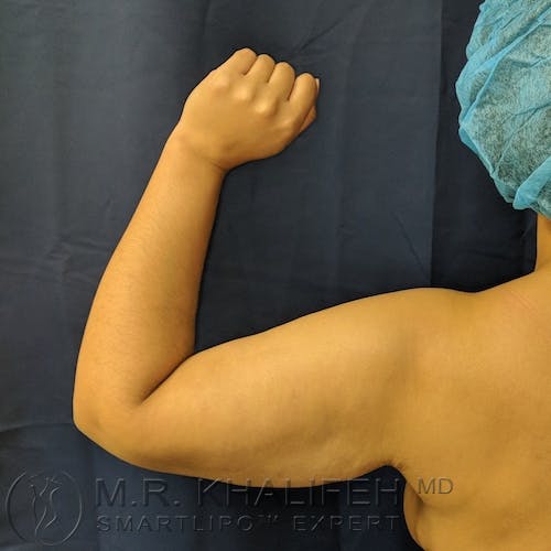 Arm Liposuction Gallery - Patient 3761807 - Image 1
