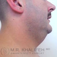 Chin and Neck Liposuction Gallery - Patient 3761805 - Image 1