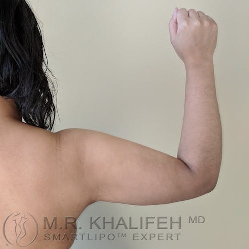 Arm Liposuction Gallery - Patient 3761807 - Image 4