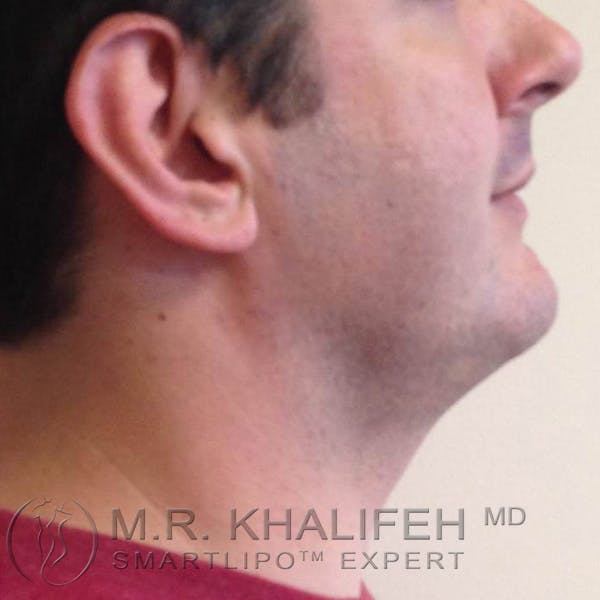 Chin and Neck Liposuction Gallery - Patient 3761805 - Image 2