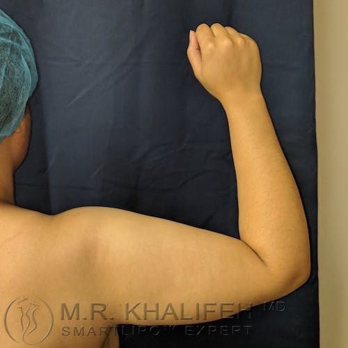 Arm Liposuction Gallery - Patient 3761807 - Image 3