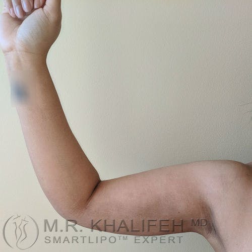 Arm Liposuction Gallery - Patient 3761807 - Image 6
