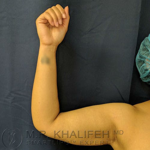 Arm Liposuction Gallery - Patient 3761807 - Image 5