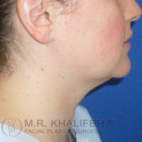 Chin and Neck Liposuction Gallery - Patient 3761830 - Image 1