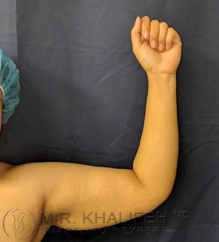 Arm Liposuction Gallery - Patient 3761807 - Image 7