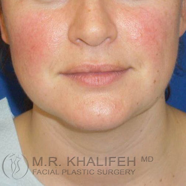 Chin and Neck Liposuction Gallery - Patient 3761830 - Image 5