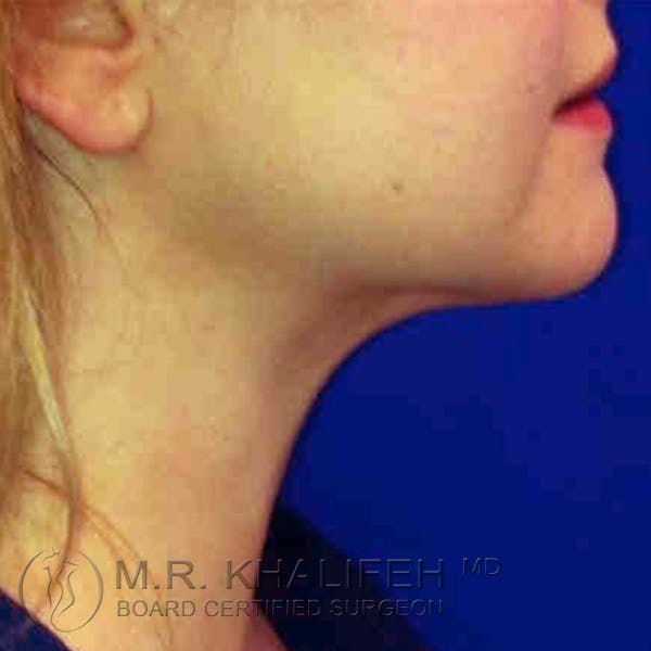 Chin and Neck Liposuction Gallery - Patient 3761839 - Image 2