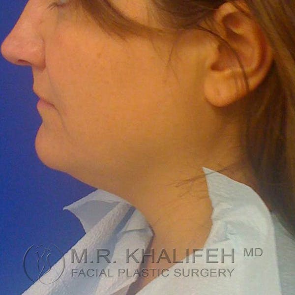 Chin and Neck Liposuction Gallery - Patient 3761847 - Image 1