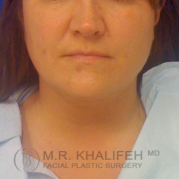 Chin and Neck Liposuction Gallery - Patient 3761847 - Image 5