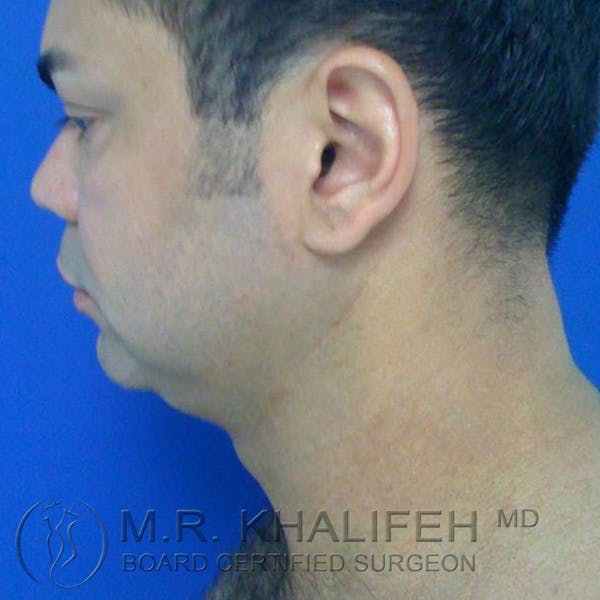Chin and Neck Liposuction Gallery - Patient 3761848 - Image 1