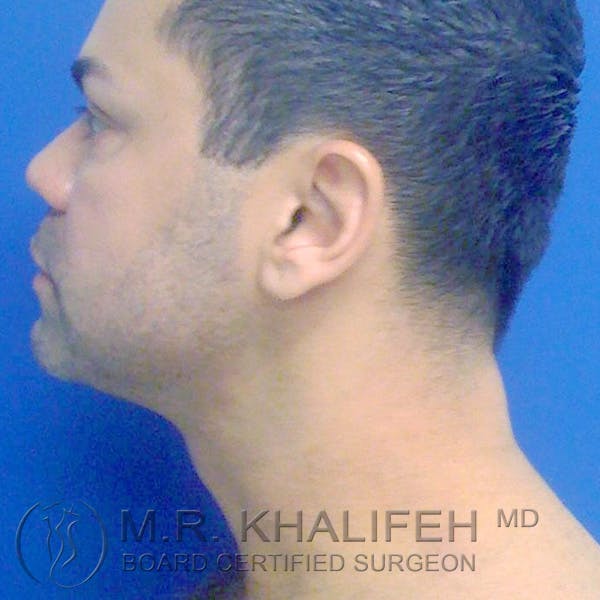 Chin and Neck Liposuction Gallery - Patient 3761848 - Image 2