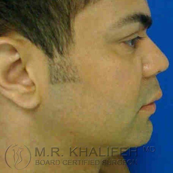 Chin and Neck Liposuction Gallery - Patient 3761848 - Image 3