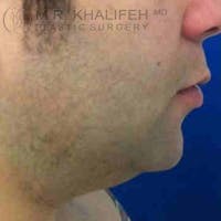 Chin and Neck Liposuction Gallery - Patient 3761850 - Image 1