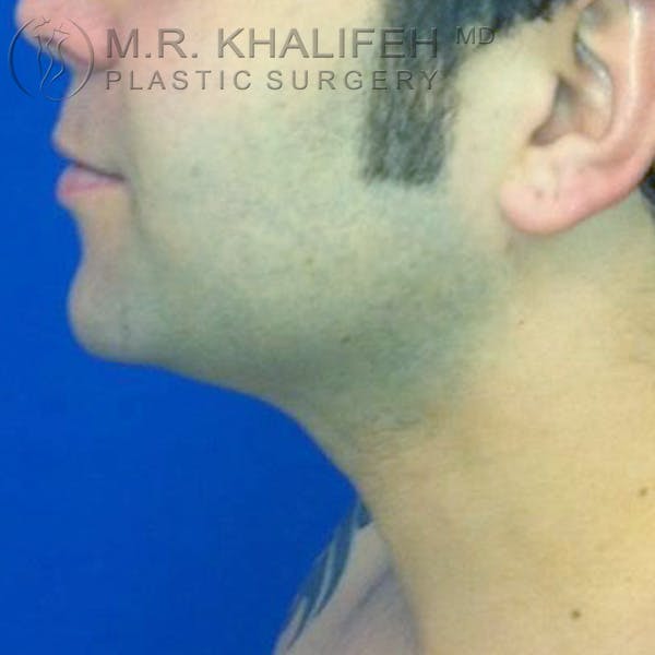 Chin and Neck Liposuction Gallery - Patient 3761850 - Image 4