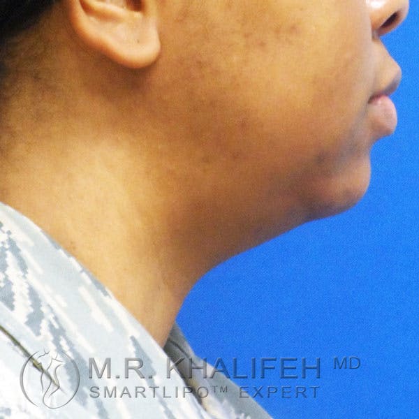 Chin and Neck Liposuction Gallery - Patient 3761854 - Image 6