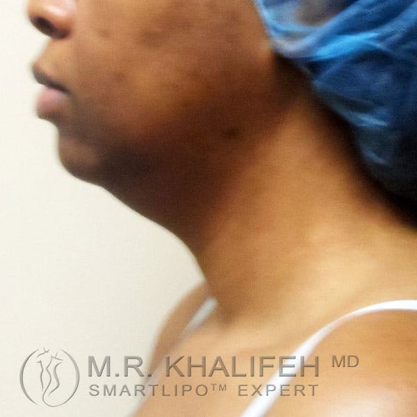 Chin and Neck Liposuction Gallery - Patient 3761854 - Image 9