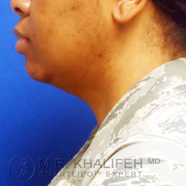 Chin and Neck Liposuction Gallery - Patient 3761854 - Image 10