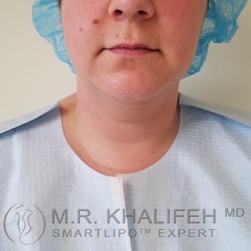 Chin and Neck Liposuction Gallery - Patient 3761856 - Image 1