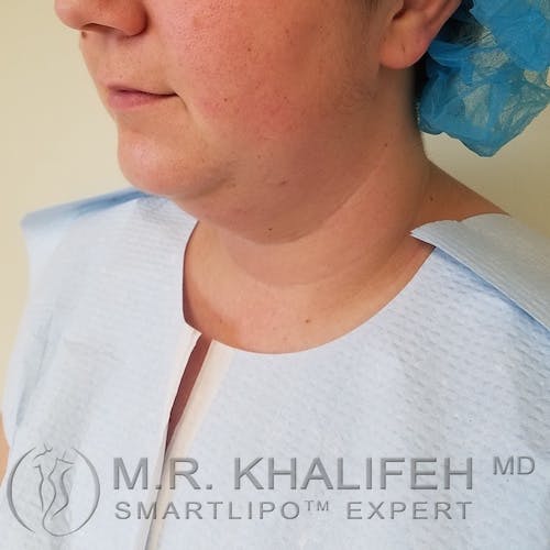 Chin and Neck Liposuction Gallery - Patient 3761856 - Image 3