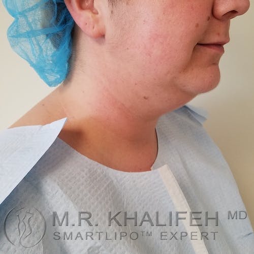 Chin and Neck Liposuction Gallery - Patient 3761856 - Image 5