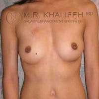 Breast Augmentation Gallery - Patient 3761894 - Image 1