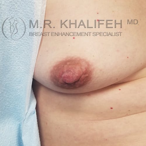 Inverted Nipple Correction Gallery - Patient 3761898 - Image 2