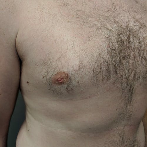 Inverted Nipple Correction Gallery - Patient 3761906 - Image 5
